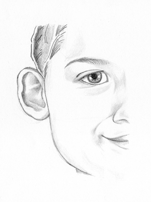 Before Ear Reshaping Surgery