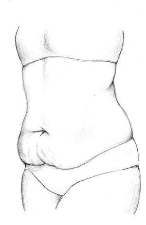 Before Tummy Tuck - Drainless Surgery